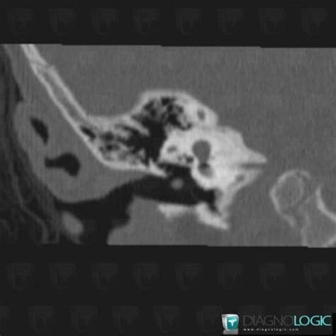 Radiology case : Cholesteatoma (CT) - Diagnologic