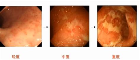 遇到肠道溃疡只知道炎症性肠病这些鉴别诊断不能漏 澎湃号湃客 澎湃新闻 The Paper