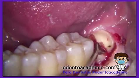 Cirugía Bucal 3er Molar Inferior Odontosección ODONTOACADEMIC YouTube