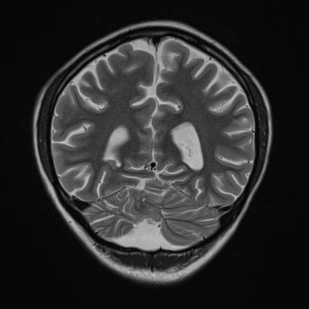 Subependymal Grey Matter Heterotopia Radiology Case Radiopaedia Org