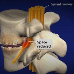 Lumbar Spondylosis - Segura Neuroscience & Pain Center