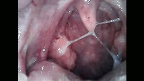 Phlegm Endoscopy Of The Throat And Nose Wmv Angiejoy Clips4sale