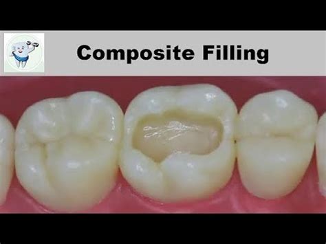 Composite Dental Filling Step by Step - Dental Clinic