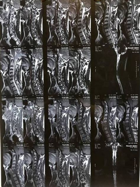 Cervical Spine Epidural Abscess Caused By Brucellosis A Case Report