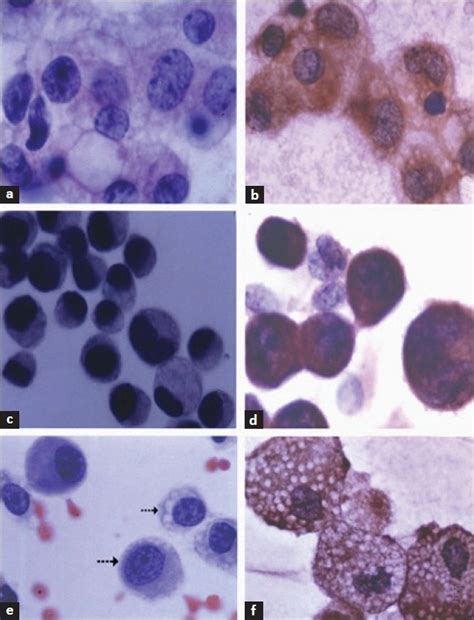 A Benign Reactive Mesothelial Cells With Vacuolated Cytoplasm And Download Scientific Diagram