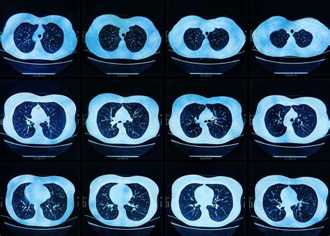 MRI scan of the human Lungs | Advanced Body Scan