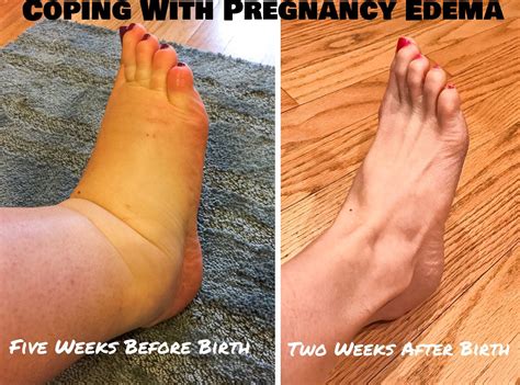 How To Manage Massive Pregnancy Swelling Be Sure To See Your Doctor If