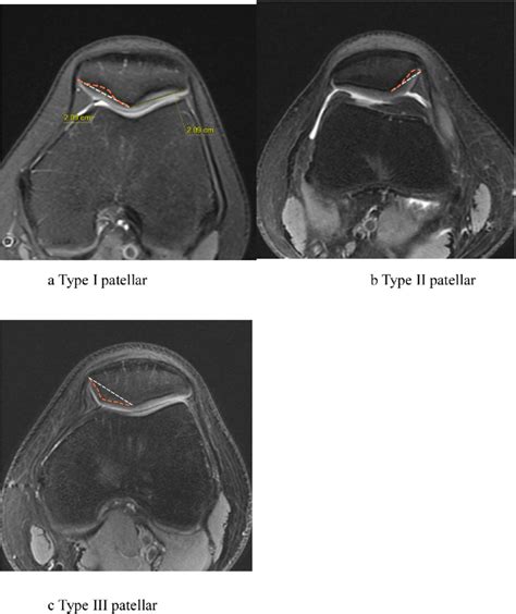 Shows The Morphological Variation Of The Patella By The Wiberg