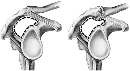 shoulder impingement syndrome bone  spine