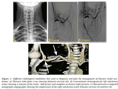 Vascular Thoracic Outlet Syndrome Biomedical Research