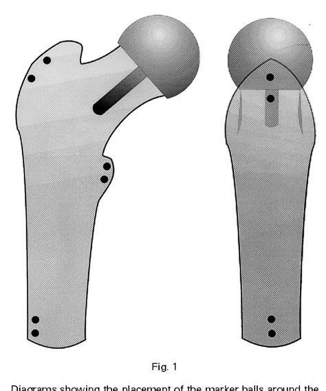 Figure From Roentgen Stereophotogrammetric Analysis Of The Birmingham