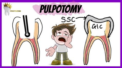 Pediatric Dentistry Pulpotomy Types Indications Procedure Youtube