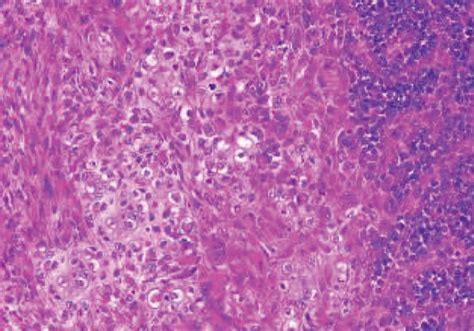 Histology image of the sarcomatous component. (a) Heterologous element ...