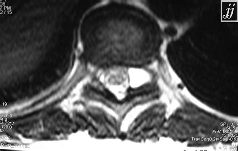 Pseudo Meningocele Or Dural Evulsion At Dorso Lumbar Junction Radiopaedia