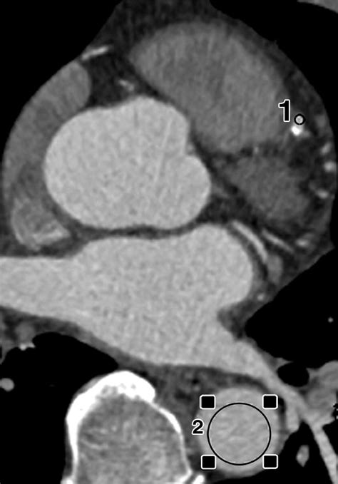 Coronary In Stent Restenosis Assessment With Corrected Coronary