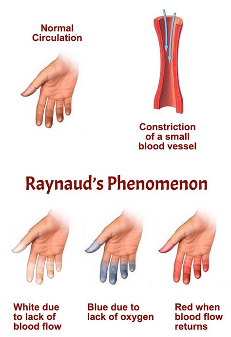 Raynaud’s Phenomenon | APS Foundation of America, Inc.