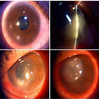 Representative Clinical Pictures Of Patients With Bacterial Keratitis