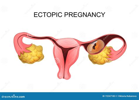 Ectopic Pregnancy The Embryo In The Fallopian Tube Infographics