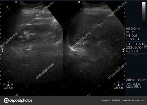 Ultrasound Examination Human Internal Organs — Stock Photo © YAYImages ...