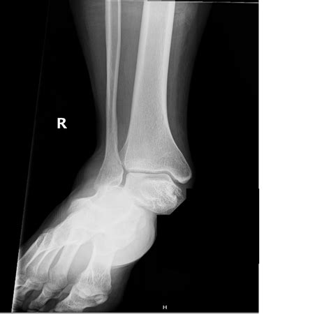 A Case Report of Lateral Subtalar Dislocation: Emergency Medicine Assessment, Management and ...