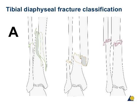 Tibial Diaphyseal Fracture