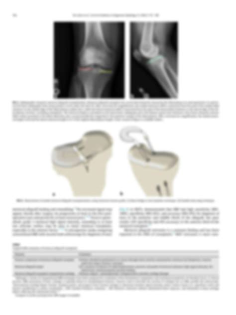 Solution Meniscal Allograft Transplantation A Pictorial Review Studypool