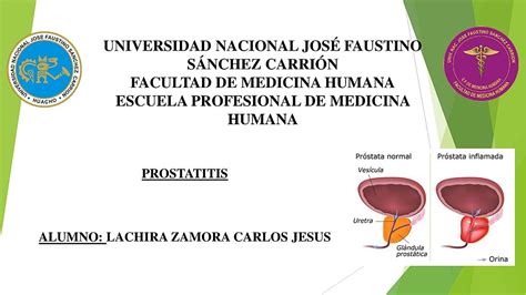 Prostatitis Carlos Jesus Lachira Zamora Udocz