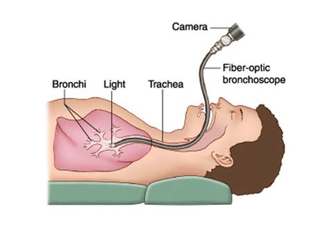 Advanced Bronchoscopy Services