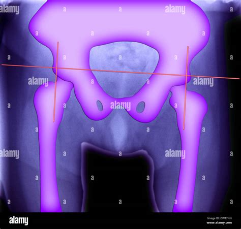 Congenital Dislocation Of The Hip Hi Res Stock Photography And Images