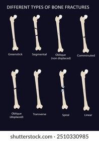 Different Types Bone Fractures Stock Vector Royalty Free 2510330985