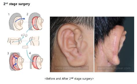 How Do We Make A New Ear Out Of Rib Cartilage For Microtia Patients