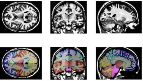 Supramarginal Gyrus Mri