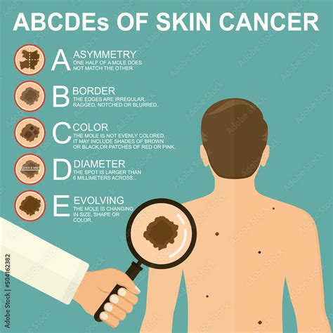 Diagnosis Of Skin Cancer Melanoma Warning Signs Dermatological