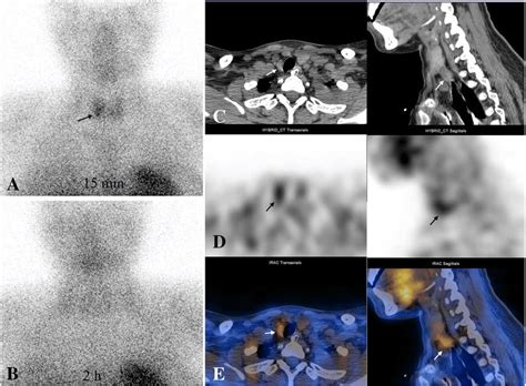 99mTc MIBI Scintigraphy And SPECT CT 99mTc MIBI Scintigraphy