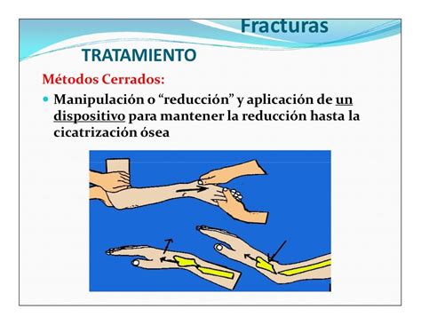 Tratamiento De Las Fracturas