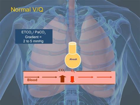 CC - EtCO2 and Waveform Capnography