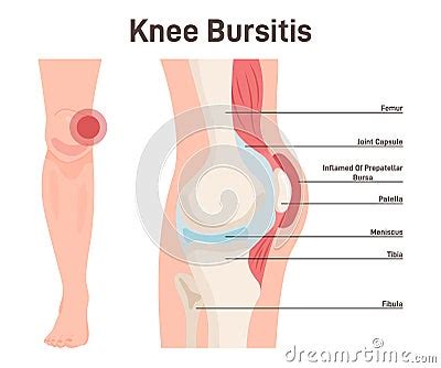 Bursitis Knee Joint Inflammation Inflamed Or Irritated Bursae Of