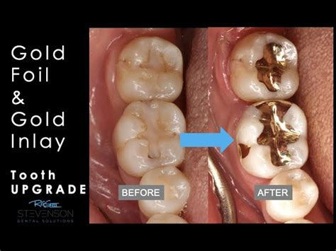 Gold Dental Fillings