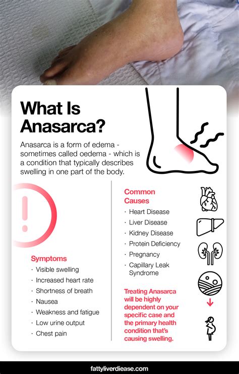 What You Need To Know About Anasarca Fatty Liver Disease