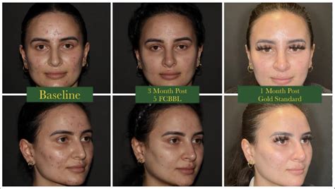 Acne Scarring Vancouver Treatment Solutions Lasers