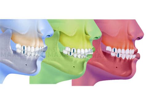 What Is A Class I Class Ii Or Class Iii Bite Instituto Maxilofacial