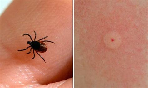 Lyme Disease