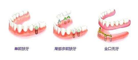 全口种植牙大概要种多少颗植体和几个牙桩固定是有关系的牙齿对比照片 8682整形网