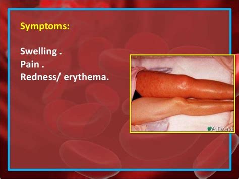 Dvt Deep Vein Thrombosis