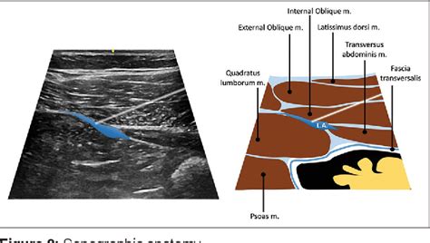 Figure 2 From Continuous Quadratus Lumborum Block As Post Operative