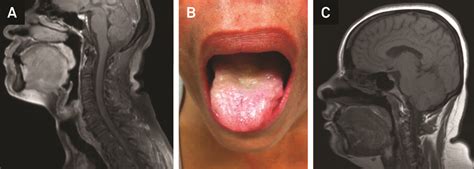 Scielo Brasil Bright Tongue Sign A Diagnostic Marker For