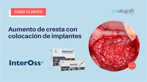 Aumento De Cresta Con Colocaci N De Implantes Salugraft Dental