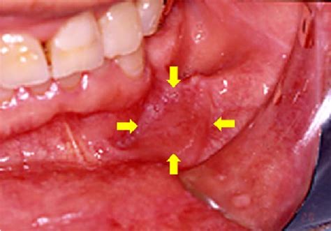 Figure 1 From A Case Of Benign Lymphoid Hyperplasia Of Buccal Mucosa