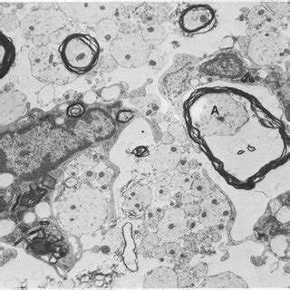 Balb C Mouse Spinal Cord Dpi Naked Axons Macrophages And Myelin