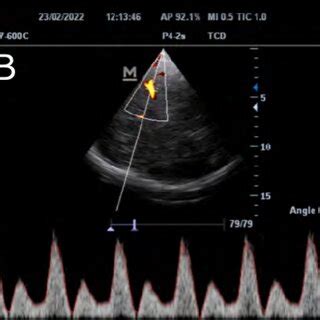 A Doppler Espectral De Acm Derecha Previo Al Aumento De La Pic Pic